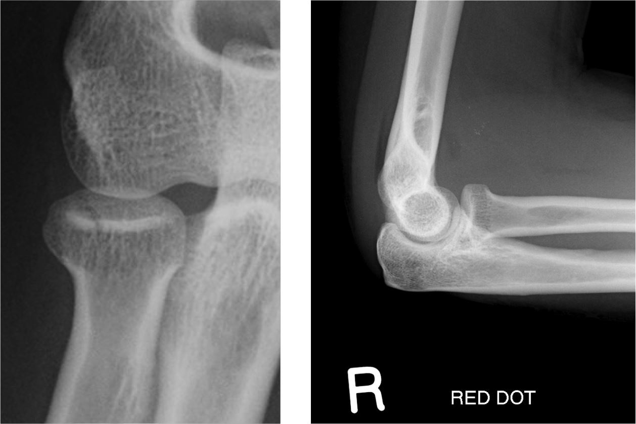 Radial Head Fracture Filnvoice 0077